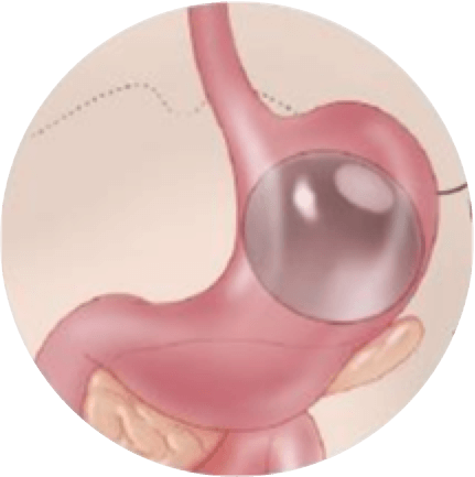 Immagine Rilascio palloncino intervento IGB